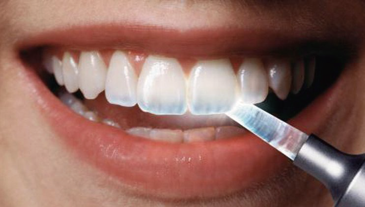 무삭제라미네이트 IPS e.max 리튬디실리케이트 소재 — 자연치와 유사한 투명도