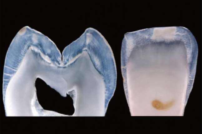 라미네이트 수제작과 디지털 CAD/CAM 비교 — 투명도의 차이