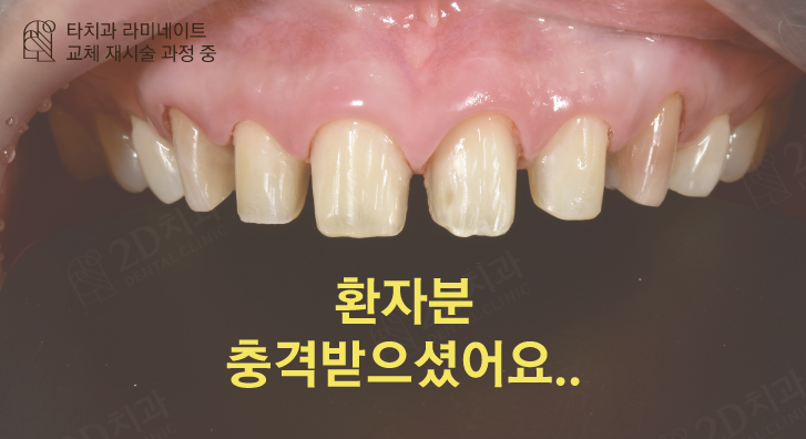 라 본문 첫 이미지 - 무삭제 라미네이트 90%가 후회한다는데 진짜 이유는?